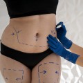 The Road to Recovery: What to Expect After a Tummy Tuck