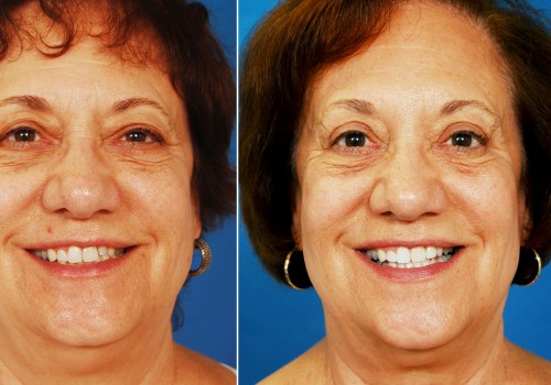 The Impact of Cosmetic Surgery on Happiness