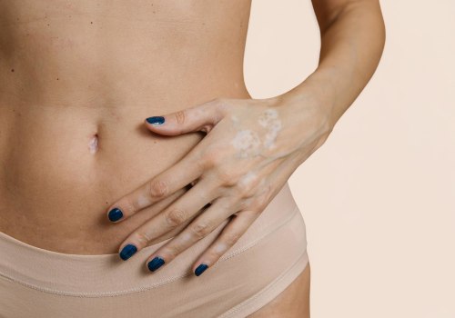 The Truth About Tummy Tucks: Are Patients Truly Happy?
