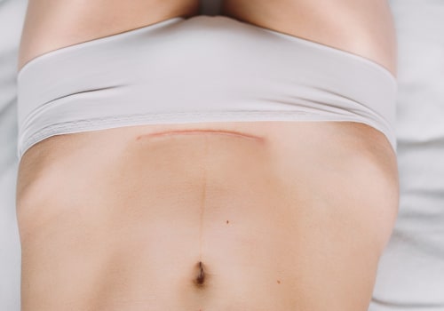 The Truth About Tummy Tuck Satisfaction Rate